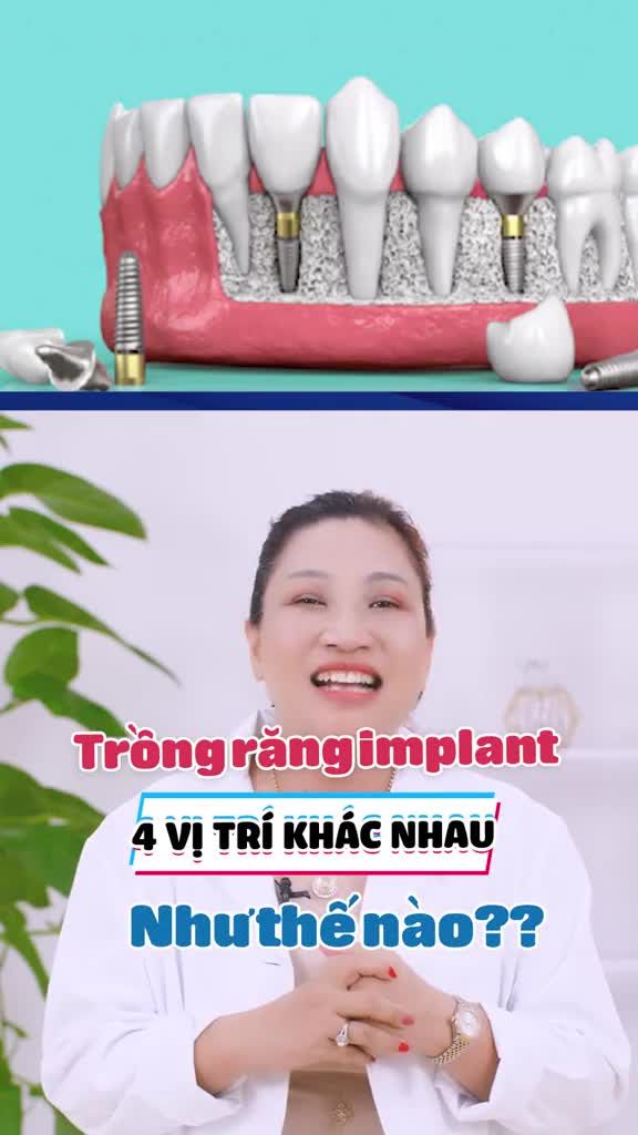 TRỒNG RĂNG IMPLANT 4 VỊ TRÍ KHÁC NHAU NHƯ THẾ NÀO ?