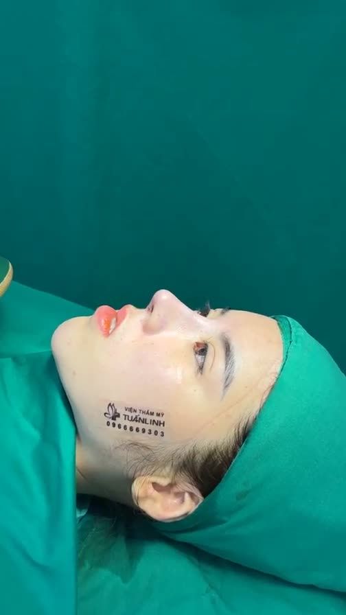 Case mũi cấu trúc vừa mới hoàn thành