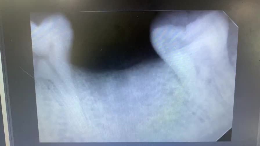 Cắm implant khôi phục răng 37 cho anh Cư.