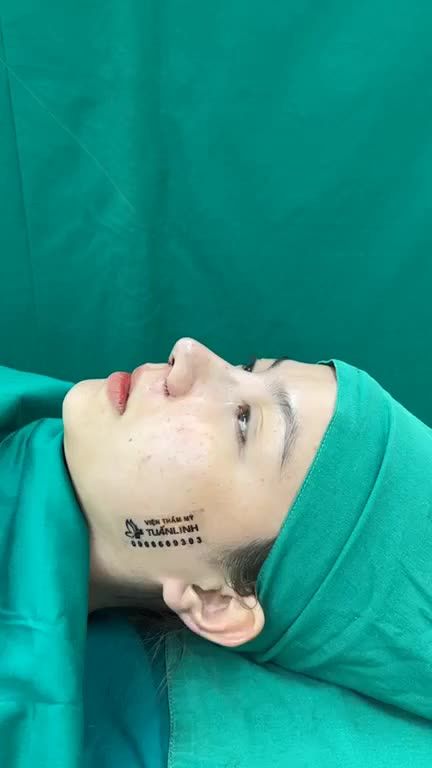 Case mũi cấu trúc cuộn cánh vừa hoàn thành