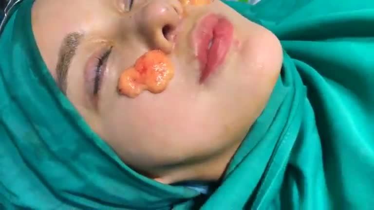 Lấy bọng mỡ má nhằm thon gọn má phính với Dr Vương !