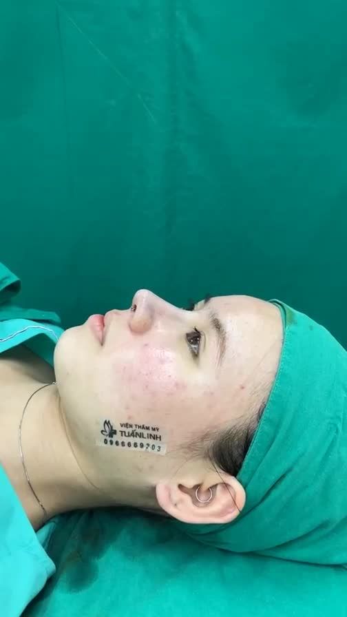 Case mũi cấu trúc surgiform vừa mới hoàn thành