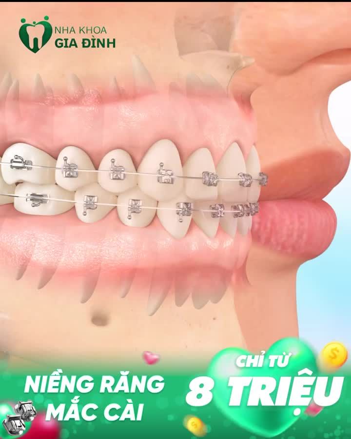 NẾU RĂNG ĐANG GẶP CÁC TÌNH TRẠNG NÀY, BẠN CẦN NIỀNG RĂNG NGAY