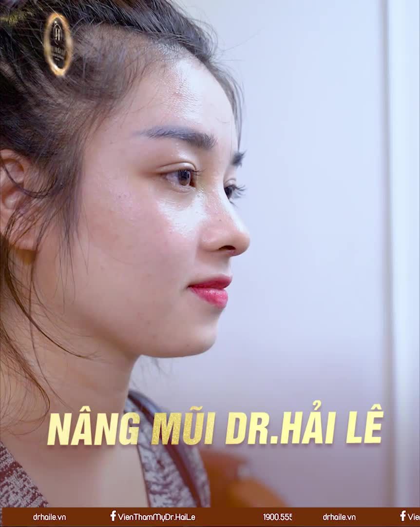 Bạn í nói chỉ thích nâng dáng mũi tự nhiên thôi, không thích cao chót vót nhìn giả trân.