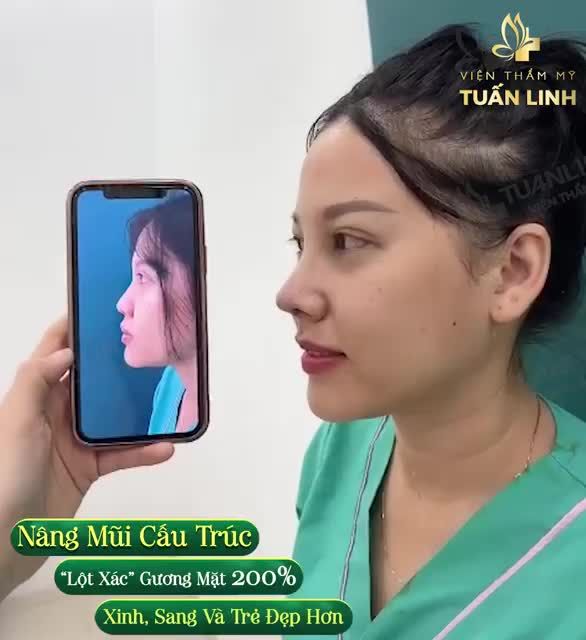 Nâng mũi giúp ''lột xác'' 200% gương mặt - Xinh hơn, sang hơn và trẻ hơn - ĐÚNG NHẬN SAI CÃI!