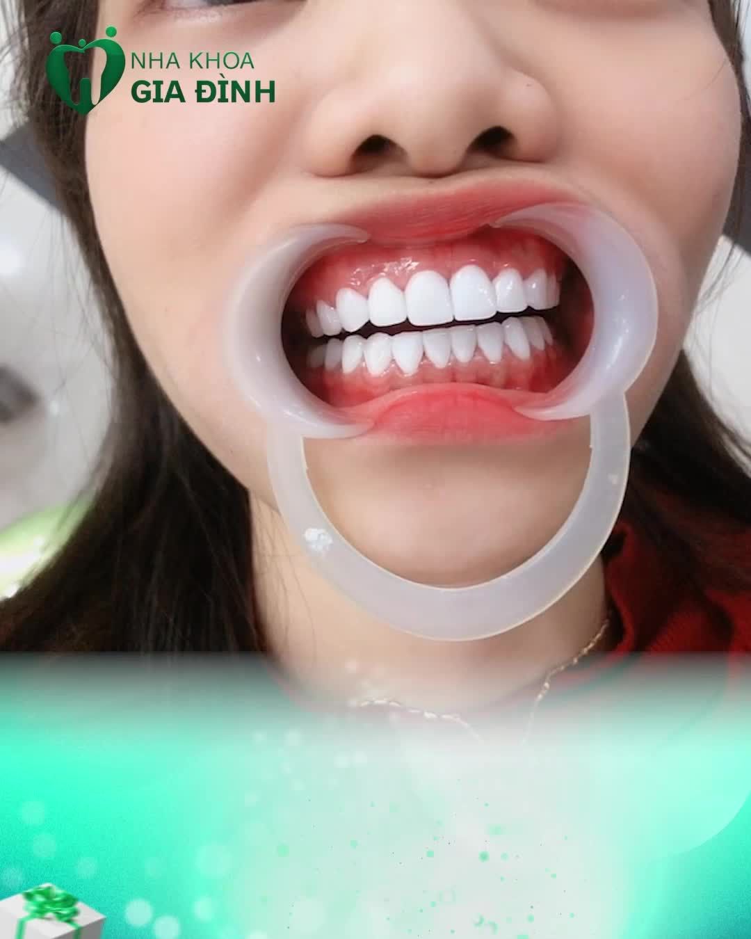CHÚ Ý! CHÚ Ý! Ở ĐÂY CÓ GIẢI PHÁP TUYỆT VỜI CHO NỤ CƯỜI CỦA BẠN