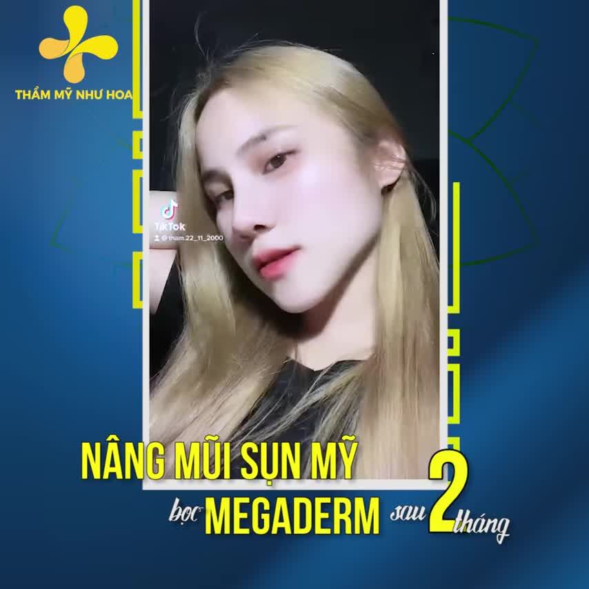 Feedback nâng mũi sụn Mỹ bọc Megaderm sau 2 tháng.