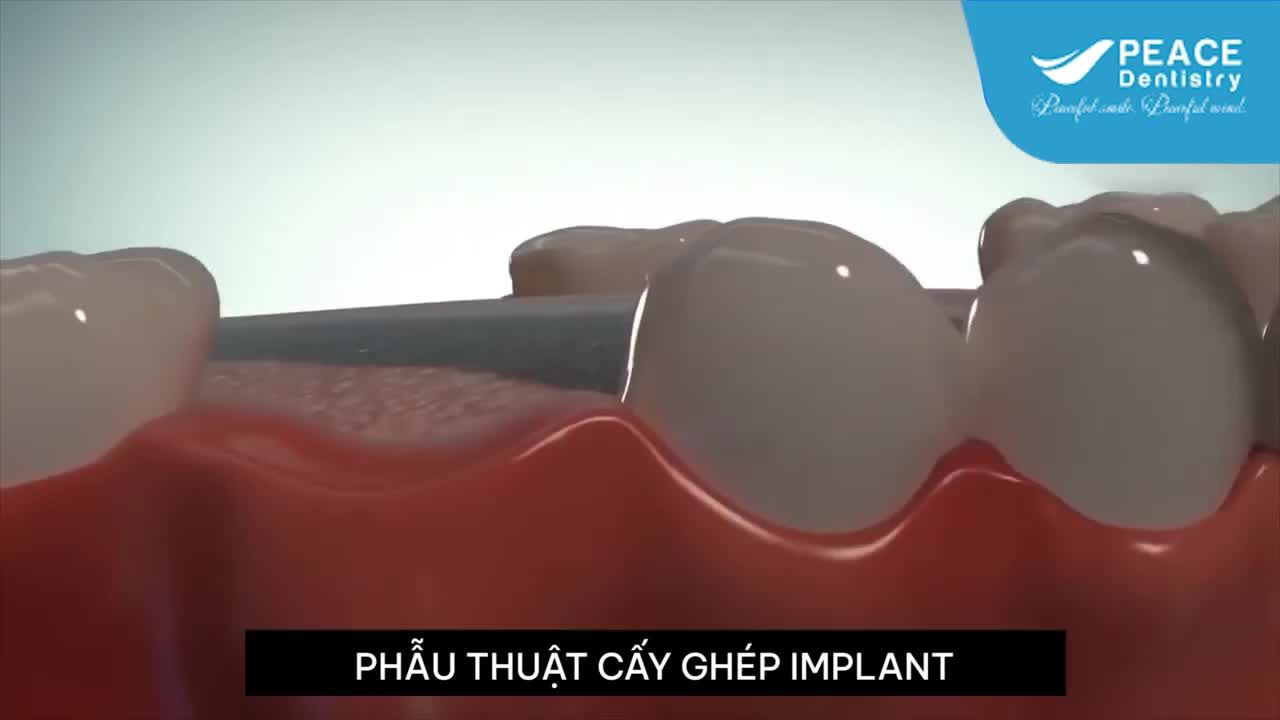 CHI TIẾT CÁC BƯỚC MỘT CA TRỒNG RĂNG IMPLANT