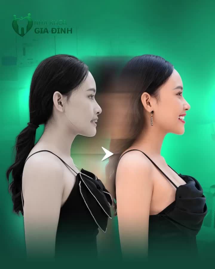 NIỀNG RĂNG LÀ CHUYỆN NHỎ - NHA KHOA GIA ĐÌNH LÀM ĐƯỢC ĐIỀU ĐÓ