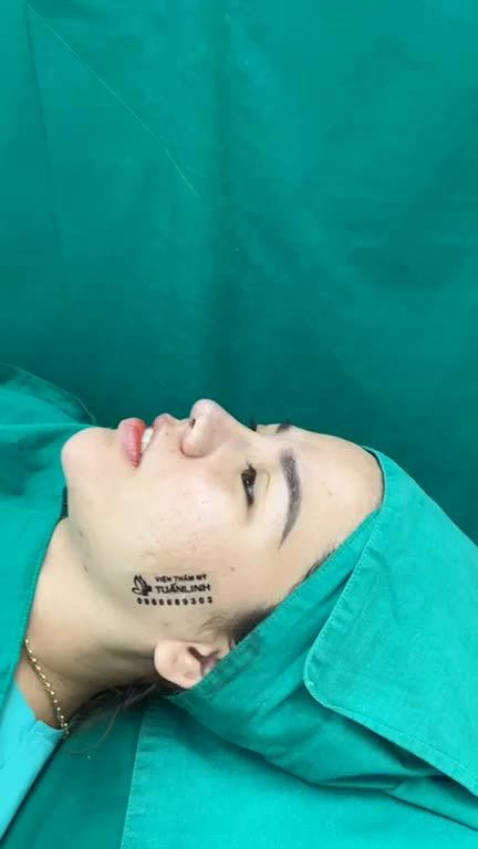 Case mũi cấu trúc sụn mỹ vừa hoàn thành