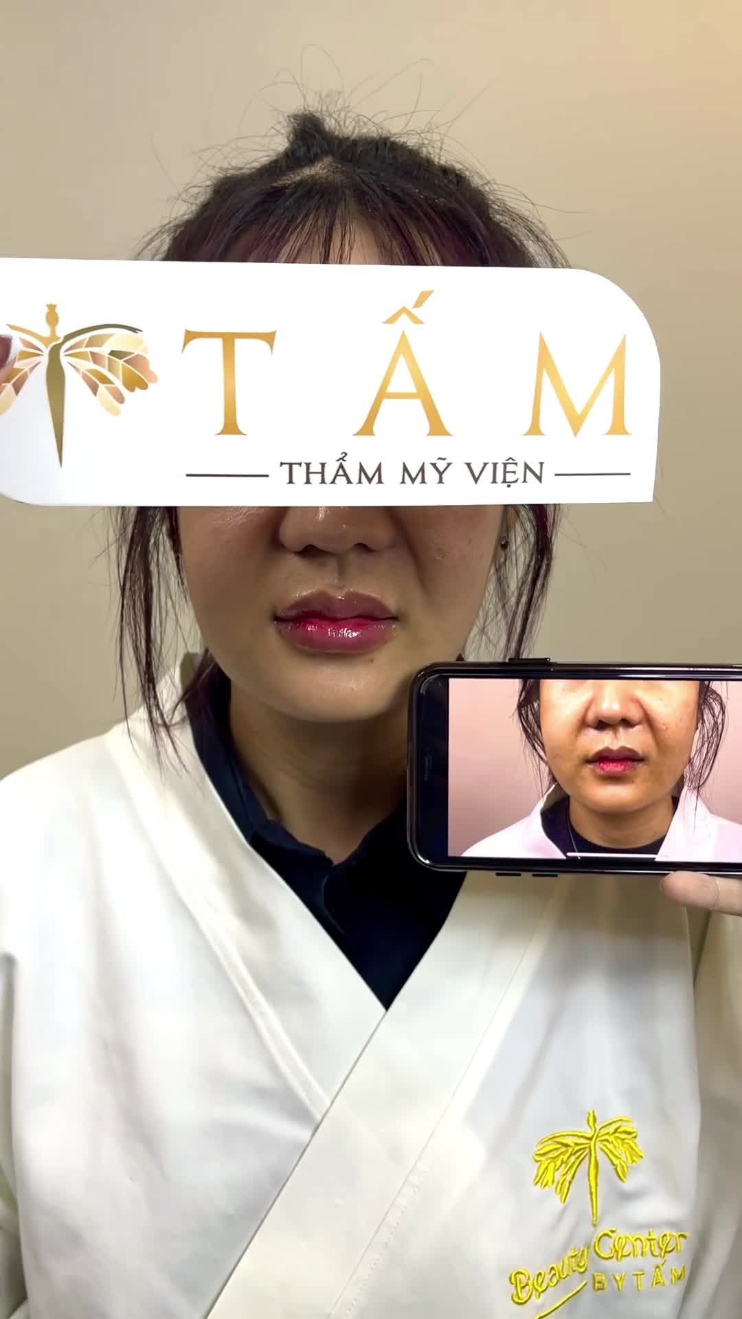 Cận cảnh ca filler môi của bạn khách hàng tại phòng khám TMV Tấm. Mọi người có thể thấy môi của bạn khách đã có sự thay đổi rõ rệt trước và sau làm.