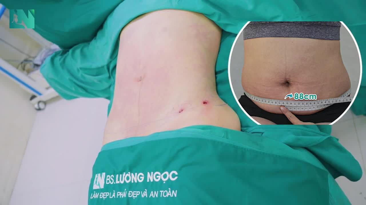 Sau 1,5 giờ thực hiện  hút mỡ tạo dáng thẩm mỹ, từ vòng bụng 88cm, ngấn mỡ chảy xệ – giảm ngay 16cm, đường eo hiện rõ rệt