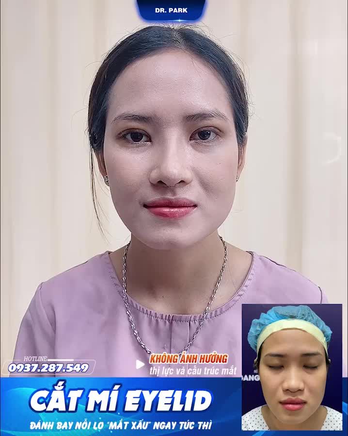 TRƯỚC KHI CẮT MÍ BẠN ĐÃ BIẾT NHỮNG ĐIỀU SAU?