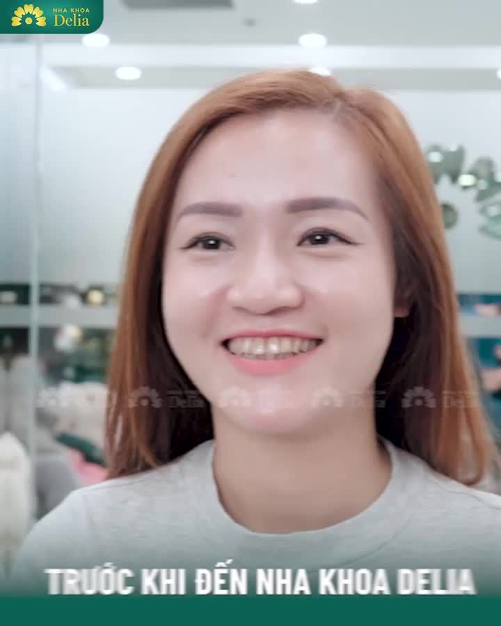 Chị Bùi Thanh sau thẩm mỹ 20 răng sứ tại nha khoa Delia.