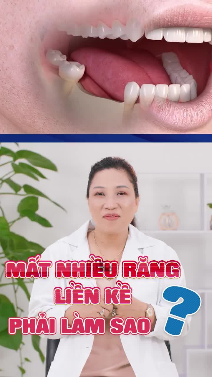 MẤT NHIỀU RĂNG LIỀN KỀ CÓ KHÔI PHỤC ĐƯỢC KHÔNG?