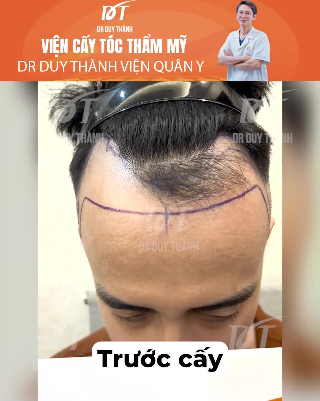 Cảm nhận cấy tóc KHÔNG đau của khách hàng nam 34 tuổi - Dr Duy Thành