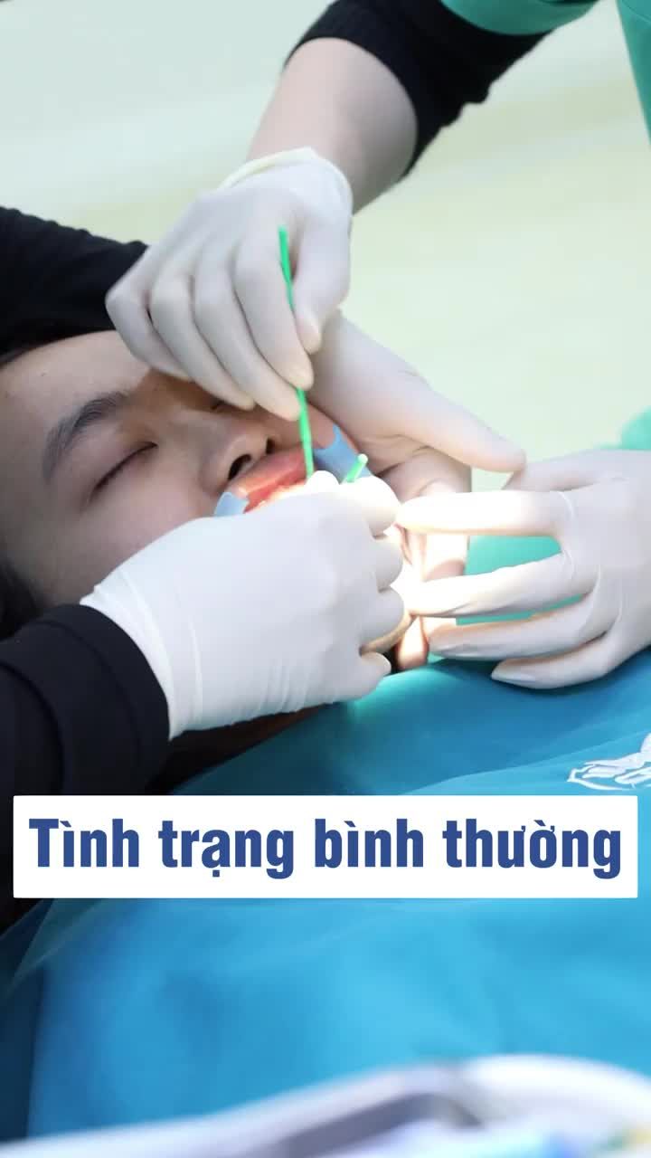 Niềng răng có bị hóp má không?