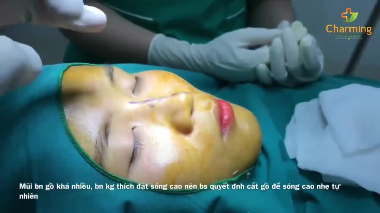 CẮT XƯƠNG MŨI LIỆU CÓ ĐÁNG SỢ NHƯ LỜI ĐỒN?