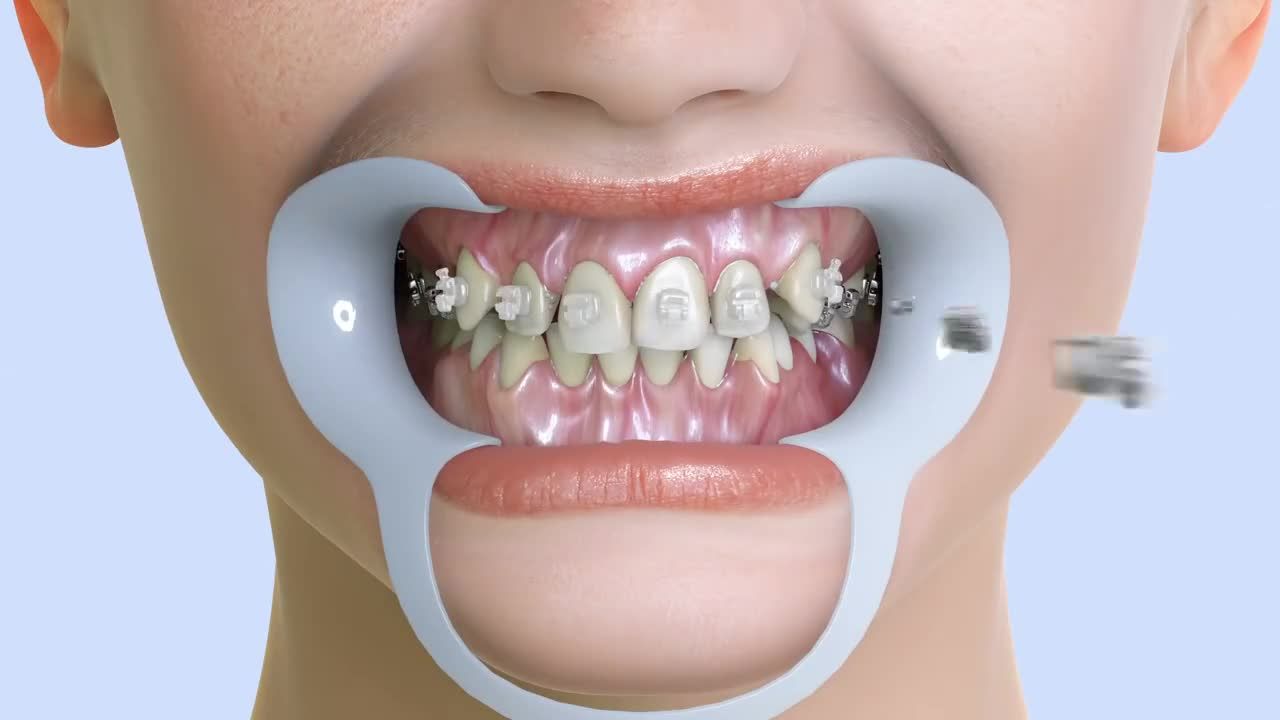 NIỀNG RĂNG CÓ THỰC SỰ THAY ĐỔI ĐƯỢC CẢ CẤU TRÚC KHUÔN MẶT BẠN?