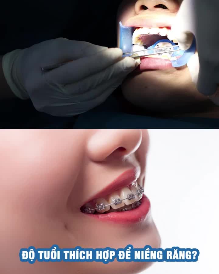 Độ tuổi thích hợp để niềng răng