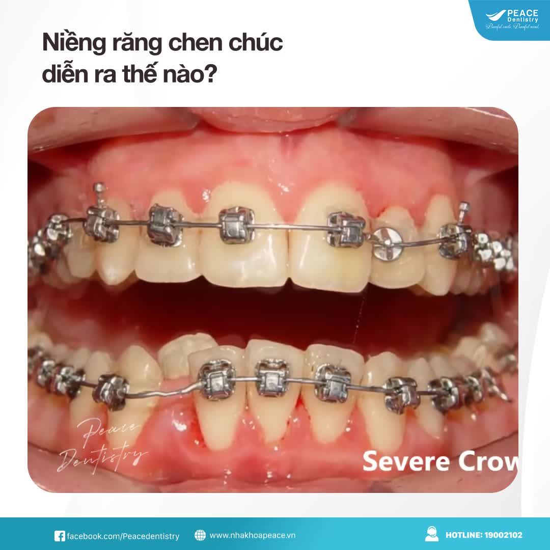 Thăng hạng nhan sắc nhờ niềng răng chen chúc
