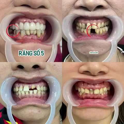 Khi bị mất răng, không chỉ làm mất tính thẩm mỹ mà còn ảnh hưởng đến chức năng ăn nhai.