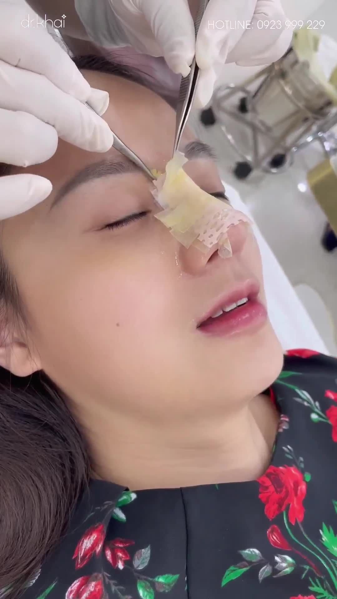 KHÁCH THÁO NẸP SAU 15 NGÀY NÂNG MŨI SỤN SƯỜN TOÀN PHẦN
