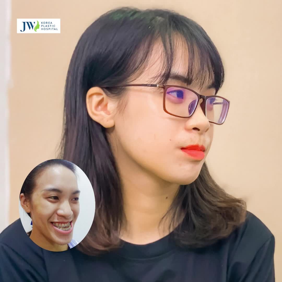 HÓA HOTGIRL CỰC TỰ TIN SAU PHẪU THUẬT HÀM MÓM