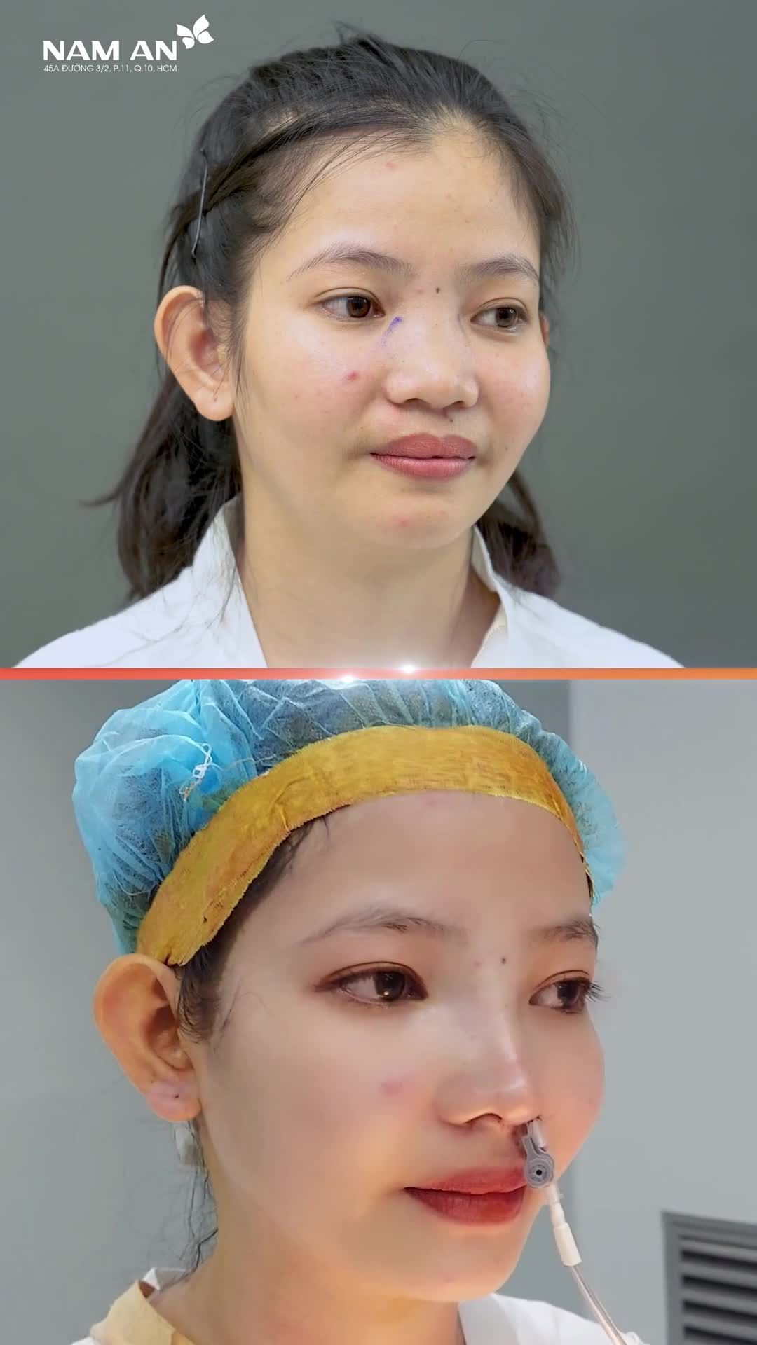 NÂNG MŨI THAY ĐỔI TOÀN DIỆN NHAN SẮC