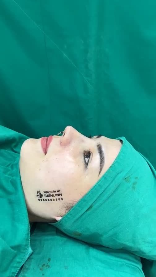 Case mũi cấu trúc cho chị gái mong muốn cao tây