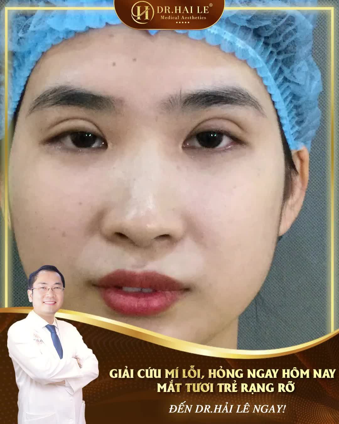 Mí lỗi, hỏng là nỗi lo lắng lớn của nhiều chị em khi thực hiện cắt mí tại các cơ sở thẩm mỹ kém uy tín