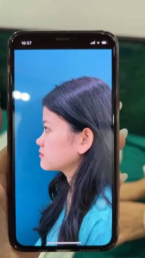 Case mũi cấu trúc được 10 ngày