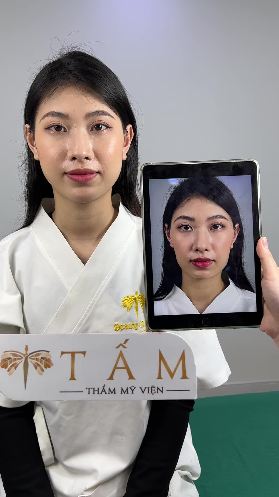 Gương mặt bạn khách sau khi cân chỉnh má, cằm nhờ Filler tại Tấm đã có sự thay đổi rõ rệt.