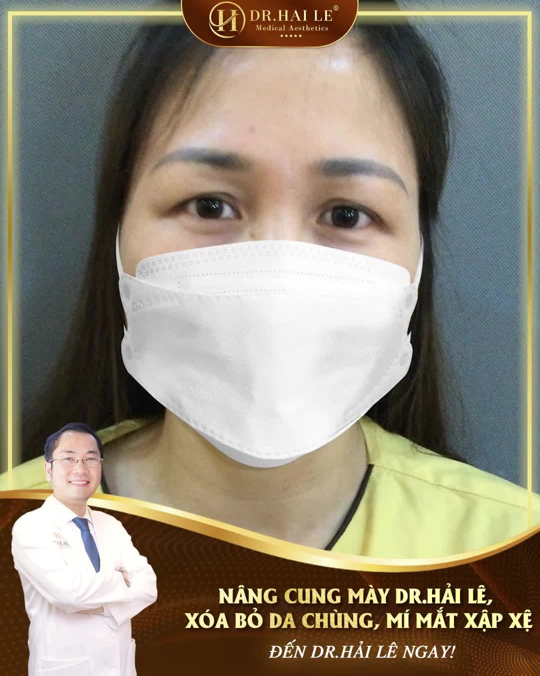 Bạn đang sở hữu đôi mắt nhiều da chùng, mỡ thừa - Mí mắt xập xệ?
