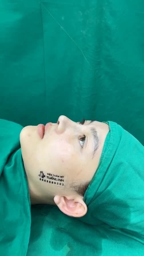 Case mũi cấu trúc vừa mới hoàn thành