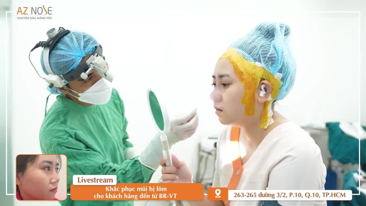 Tái tạo dáng mũi cho khách hàng từng nâng mũi bọc sụn