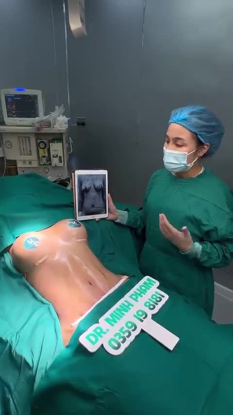 Ca Nâng ngực + Hút mỡ tạo hình thành bụng được thực hiện xong bởi ekip Dr.Minh Phạm
