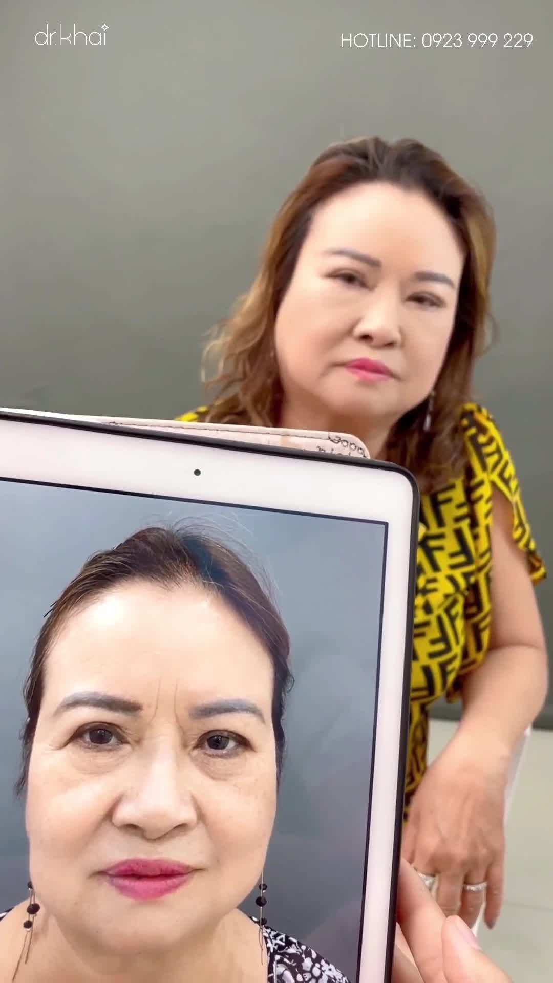 CHỊ KHÁCH NA UY VỀ NƯỚC LÀM ĐẸP TẠI BV THẨM MỸ NAM AN CỦA BÁC SĨ KHẢI