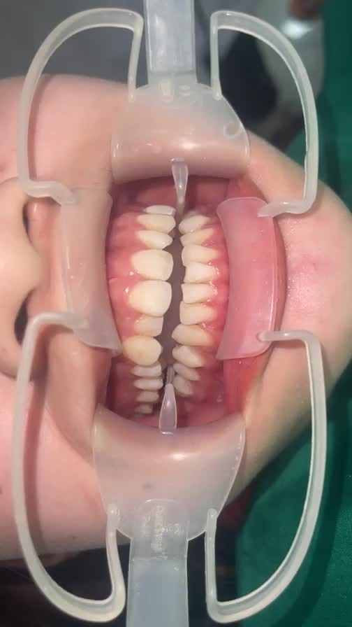QUY TRÌNH GẮN MẮC CÀI NIỀNG RĂNG, ĐIỀU TRỊ RĂNG KHẤP KHỂNH, SAI KHỚP CẮN