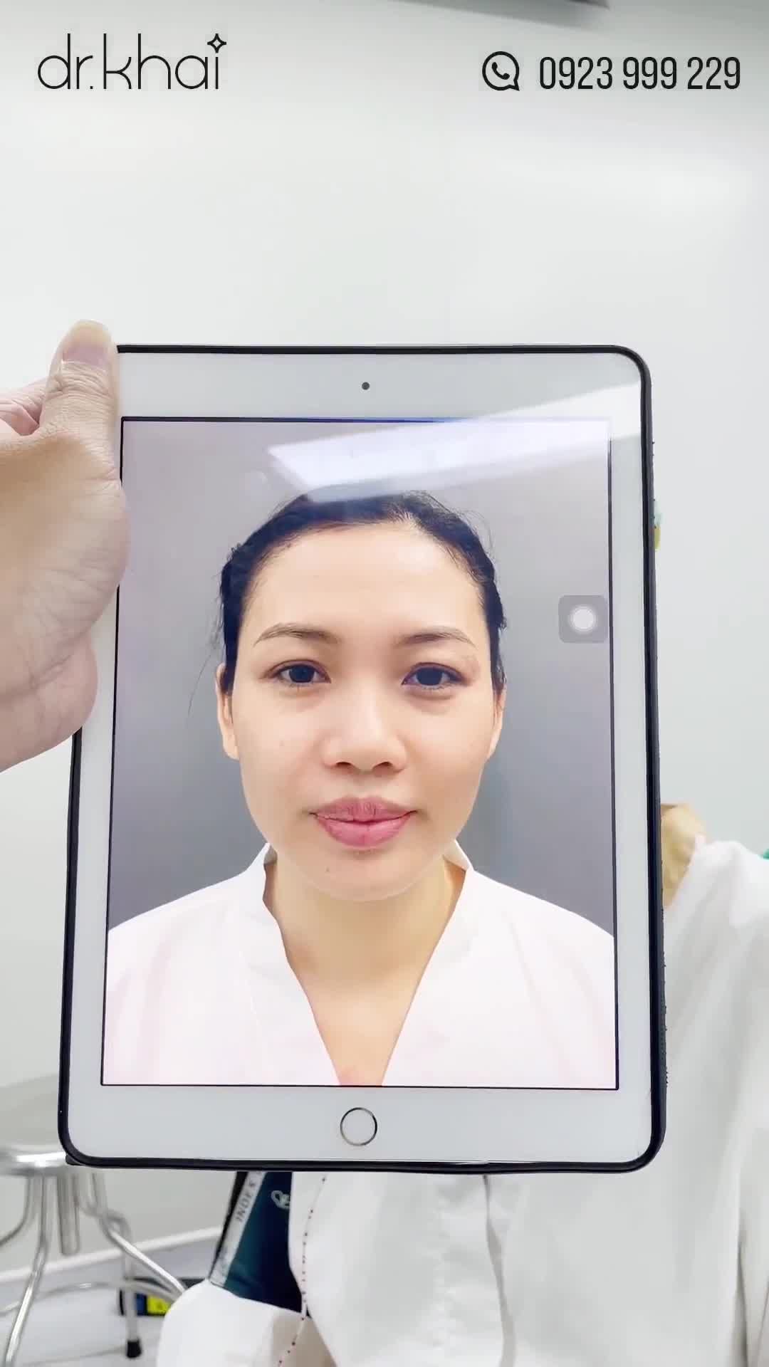 LỘT XÁC CHỈNH DÁNG MŨI TO THÔ