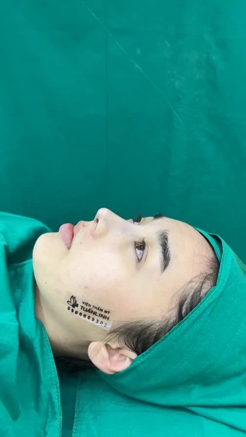 Case mũi cấu trúc vừa mới hoàn thành