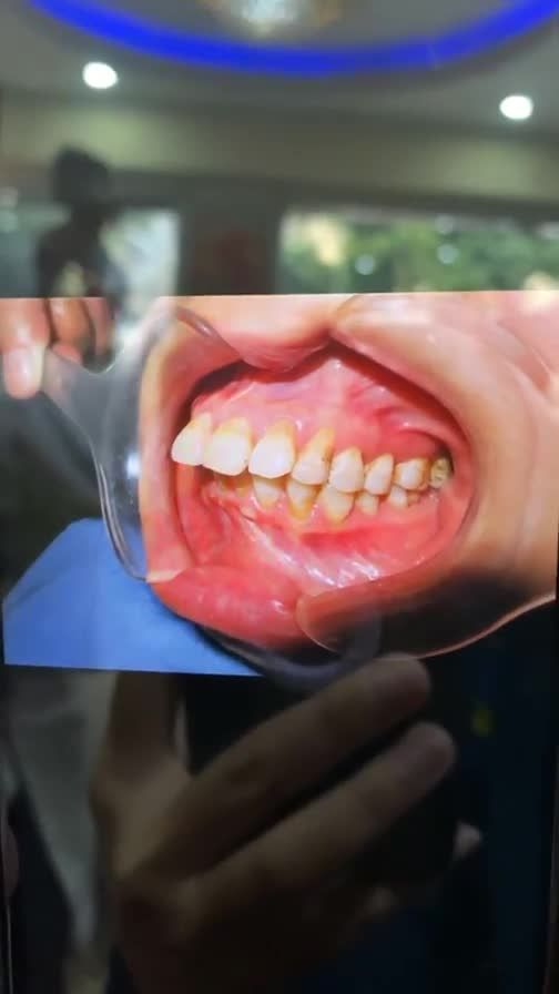 NIỀNG RĂNG CHƯA BAO GIỜ LÀ QUÁ MUỘN