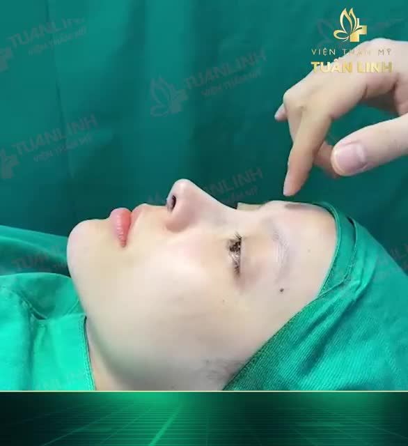 CHIA TAY MŨI HỎNG - LẤY LẠI DÁNG MŨI ĐẸP CHUẨN TỈ LỆ VÀNG!!