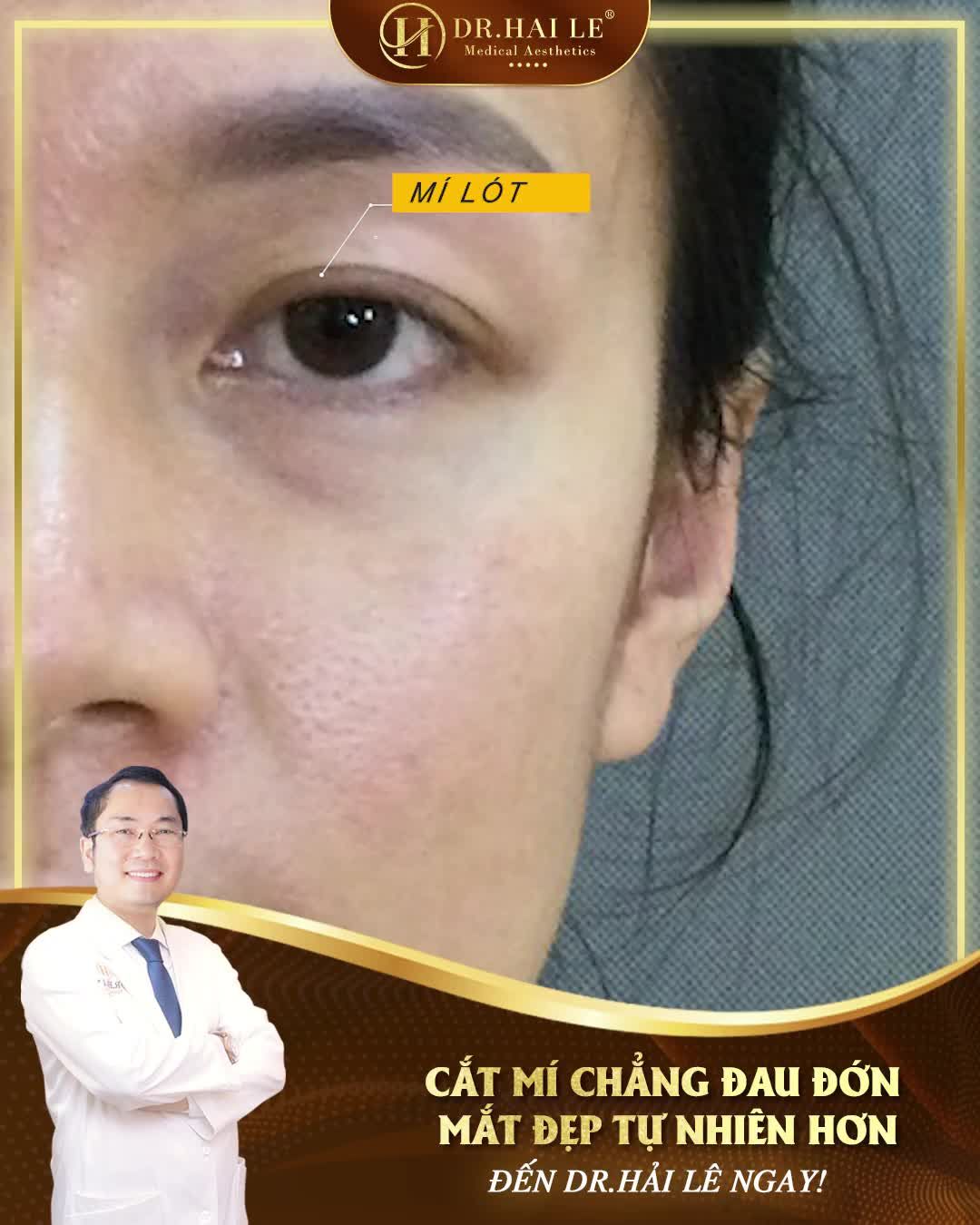 Cắt mí liệu có đau như mọi người vẫn review?