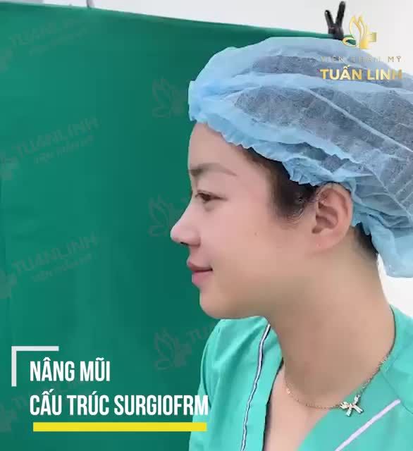 CẬN CẢNH CHIẾC MŨI CẤU TRÚC SURGIFORM SAU 90 PHÚT THỰC HIỆN.