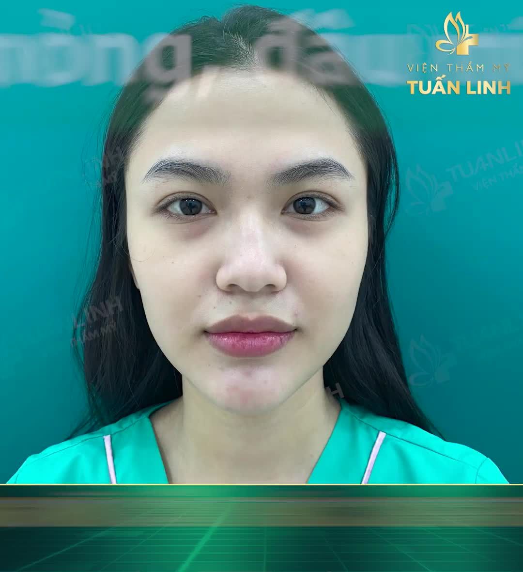 HÀNH TRÌNH 10 NGÀY SỞ HỮU DÁNG MŨI CỰC PHẨM.