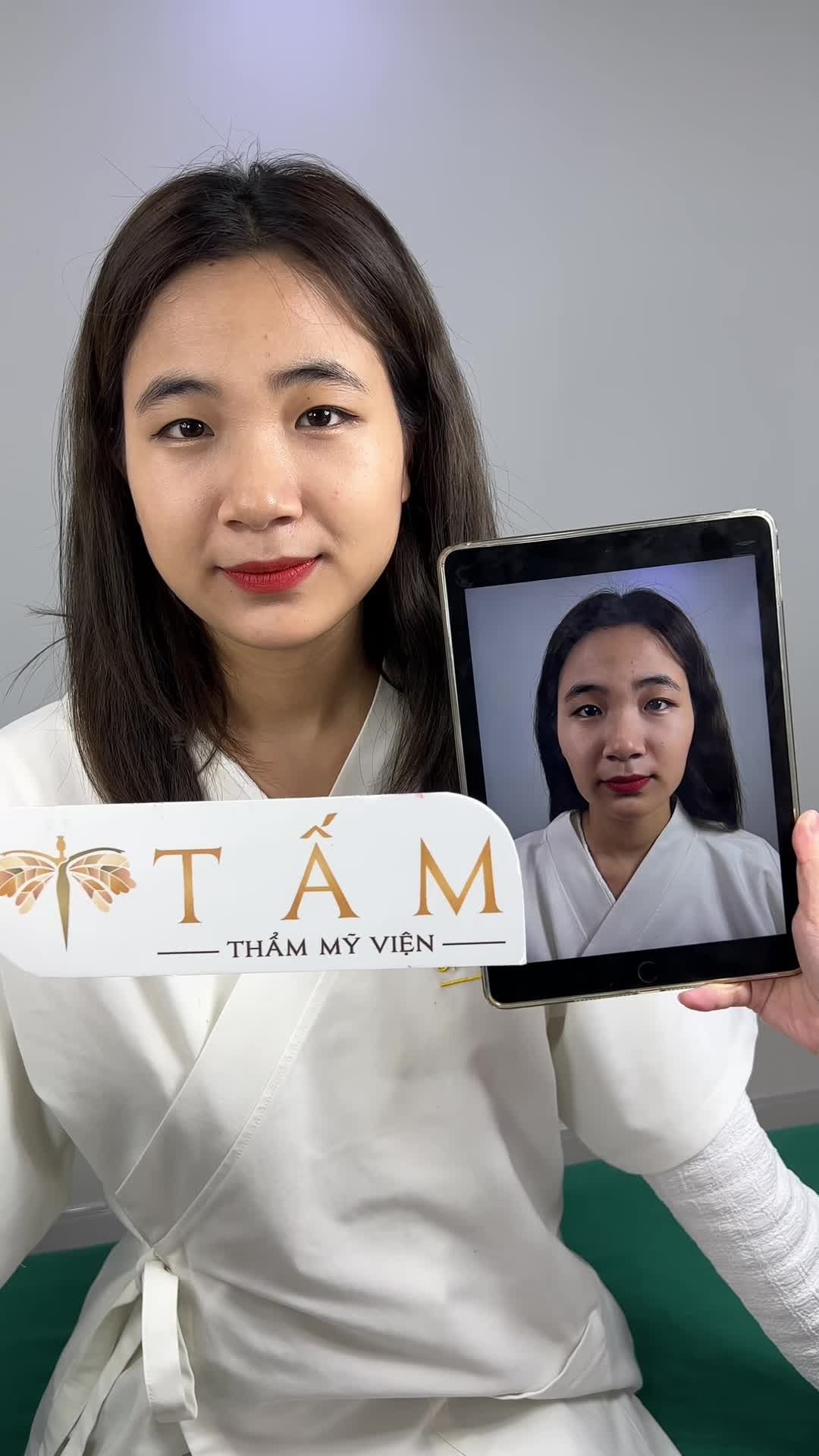Bạn khách hàng sau khi trải nghiệm dịch vụ Filler Má đã có sự thay đổi rõ rệt.