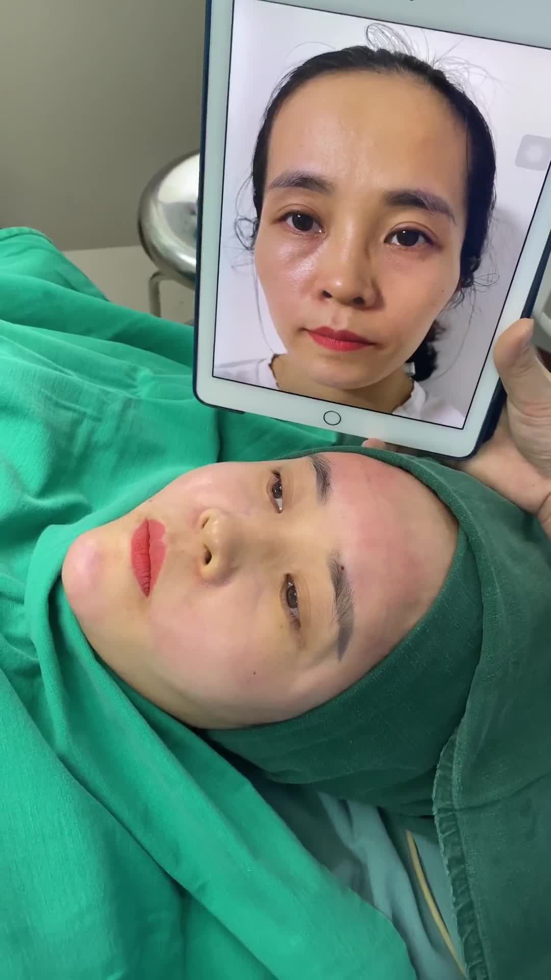 Ca Cấy mỡ mặt được thực hiện xong bởi ekip Dr.Minh Phạm