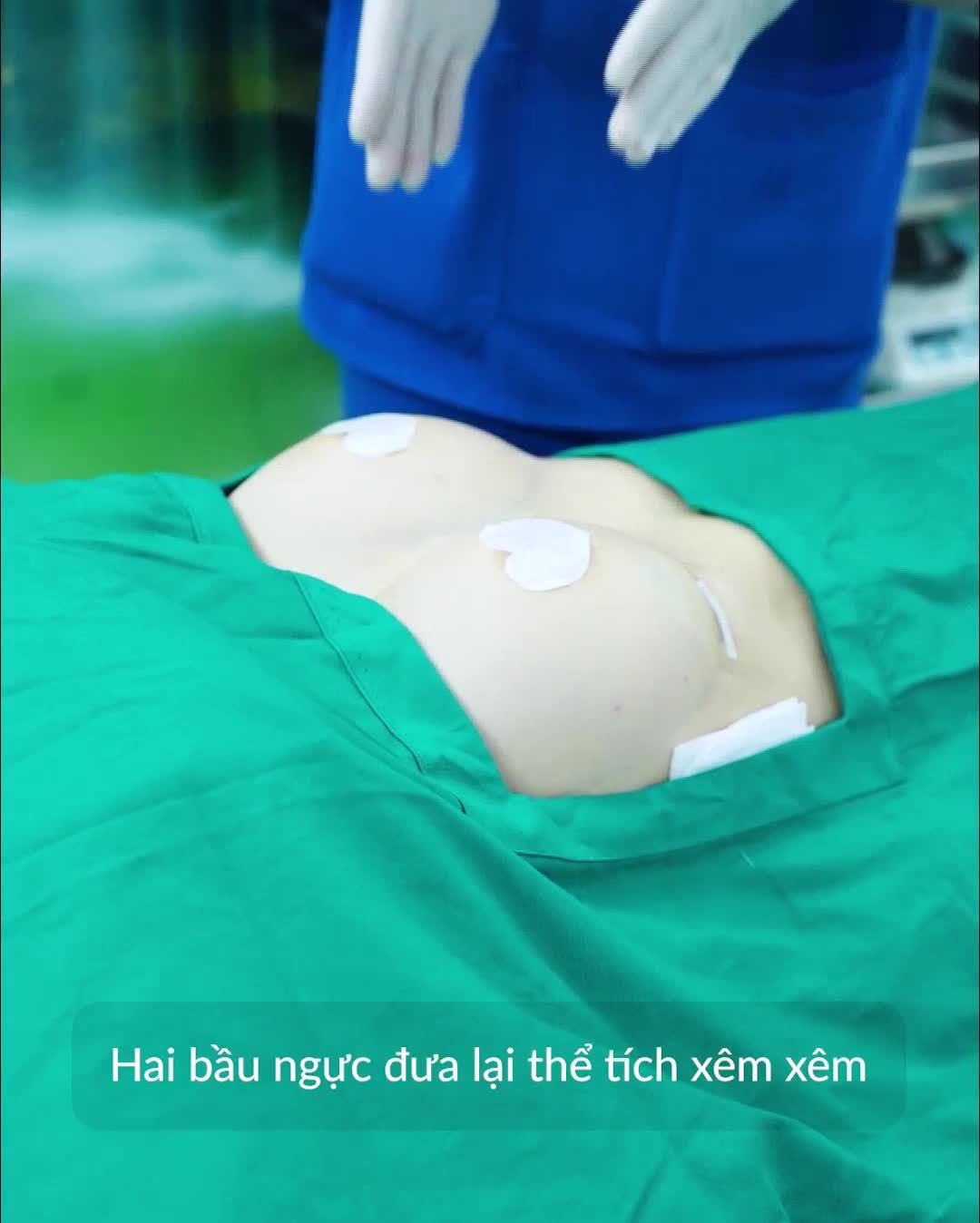 Nâng ngực TC 7 ngày hồi phục