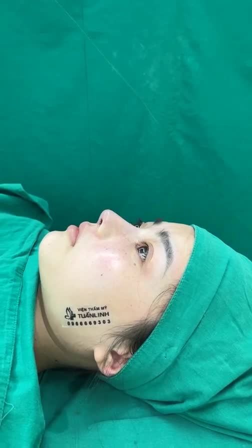 Case mũi cấu trúc sửa lại vừa hoàn thành